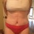 15 Days Post Op. Wanted to see how low my scar is, so I pulled out the lowest cut pair of undies I could find. So pleased with my scar placement and my results, although I'm still quite swollen.