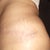 Left scar 14 weeks