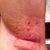 2nd Treatment - Day 1