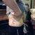 6 days post op, side view!