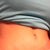 AFTER: (4 weeks post op) Look at where that mole is!