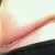 1 wk PO close-up, other side. No drain. I had 1 only.