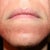 Day #3 chin - you can see the few tiny whiteheads
