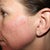 Day #4 left - pretty much all the skin has sloughed off, but you can see the roadrash areas on my chin and pinpoint bleeding areas. You can see that the age spot on the left has come off.