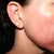 Day #4 right - pretty much all the skin has sloughed off, but roadrash areas around mouth are rough and pinpoint bleeding in areas.