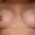 6 weeks post op.