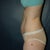 Pre-op side view