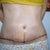 Day 5 post-op. Vertical incision from old belly button.