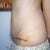 Day 5 post-op side view