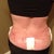 post op 1 DAY