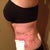 post op 1 DAY