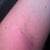 See?  The arm bruise IS worse.  I told the anesthesiologist to use the other arm!