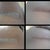 Incision Day 6, 14 Post op left and right
