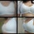 6 Days Post op and obviously the before shots, Today was the day i felt the greatest physically and then every day after has been better.