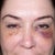 72 hrs after Artefill.  Massaging is helping to make each eye symmetrical.  Bruising is still there.
