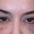 4th day.  Makeup and concealer only minimally covers this dark bruising. I am happy with the symmetry.  I read on Real Self this might take 10 days for bruising to disappear.  As long as it looks even I will be okay.