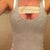12 days post op