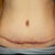 close up of scar at 6 months, again the day after steroid shots