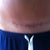 11 weeks post op