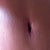 11 weeks post op