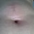 Front view of boil that I squeezed on Day 15. There was blood initially then yellowish pus that came out. The area is swollen n hard.  Worried.