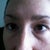 swollen, painful upper lids. Eyes are completely hooded and lid is not visible. Feels heavy and uncomfortable 24/7.