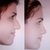 Actual before and afters taken by Dr.C! 3 months later!