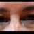 My eyelids PreOp.
