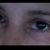 Eyelids PostOp 3 weeks. You can see the redness of the chemical peel under my eyes.  My PS said it will take about 6 weeks for the redness to subside.
