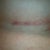 Incision 6 weeks