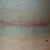 Incision 6 weeks