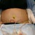 Post Op Day 4 Very swollen and Lipo stitches removed. Wrinkles from the binder NOT stretch marks.