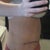 Post op day 9