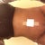 12d po a lot of hard swelling at lower abd