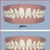 Clincheck Before and After
