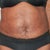 front view 17 days post op.  I am seeing a difference..