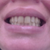Tray 21 without aligners