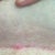 Ouch! Ingrown on incision line :(