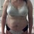 Before Pic.  Taken Day of Surgery.  Can't believe how bad it looks!