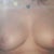 After pic - to correct severe asymmetry. 
(Ignore the underwire mark below!)