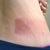 bruising 3 days after treatment 