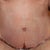 2 days post-op