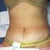 Day 2 Post Op