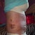 bruising from lipo
