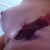 AFTER EXPLANT - SIDE VIEW WITH BLOOD BUBBLE