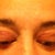 Scar line