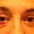 Eyes off swelling??