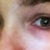 no bags, just red/blueness under eye
darkness didn't exist before surgery!