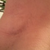 day 25 right incision