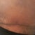 Scar @ 4 wks (right side)
